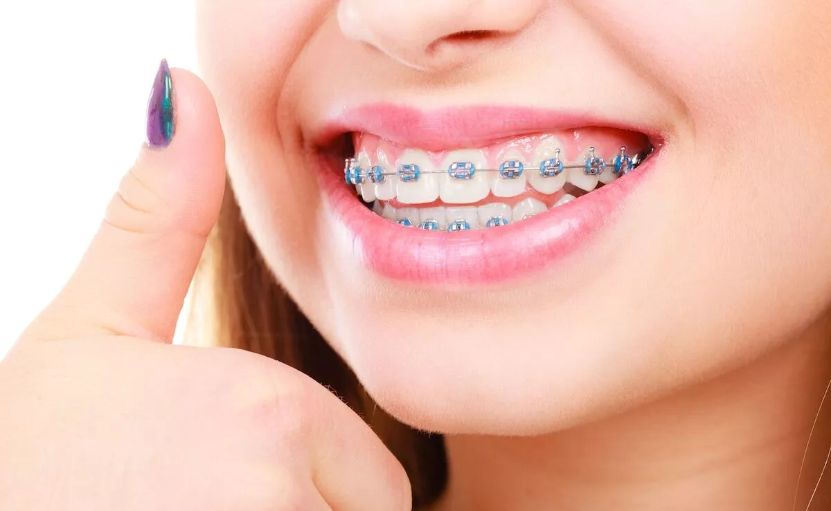 Dental Braces 